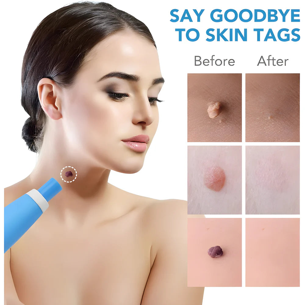 Best skin tag remover - cosmetic tools | 2025 | fast shipping