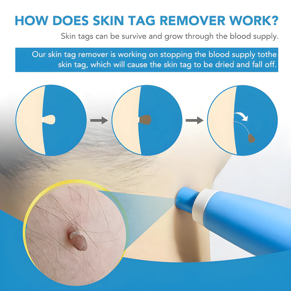 Best skin tag remover - cosmetic tools | 2025 | fast shipping